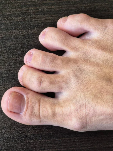 Higroma. Ayakta higroma var. Bacağında higroma var. Sıvı dolu büyük bir kist, eklem ile ilişkilidir..