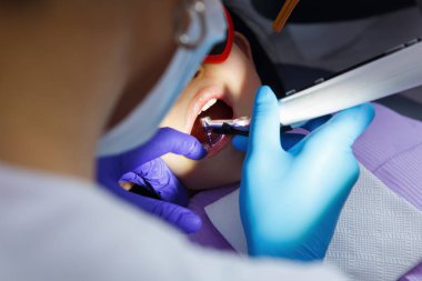 Küçük bir çocuk dişçiye dişlerini kontrol ettirirken, dişçiler matkap kullanılarak yakından inceleniyor ve tedavi edilirken, çocuk dişçi sandalyesinde ağzı açık bir şekilde yatıyor..