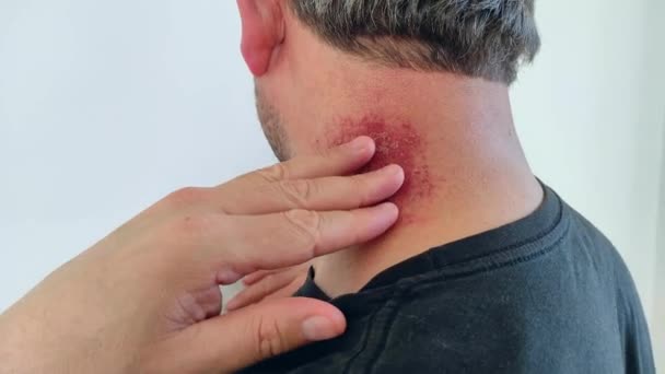 Ein Mann Der Nach Muskelsteifheit Nackenbereich Rot Und Geprellt Ist — Stockvideo