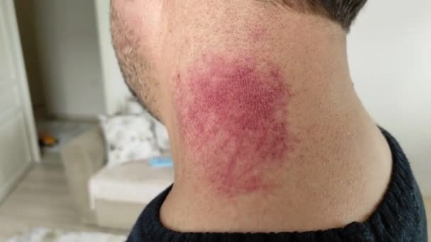 Boynundaki Kaslar Kasıldıktan Sonra Kızarıp Yaralanan Bir Adam — Stok video