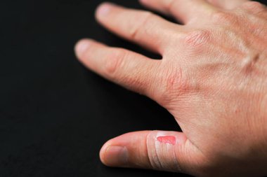 Parmaklarının arasında deri yüzen, bir kişinin eli yaralı.,