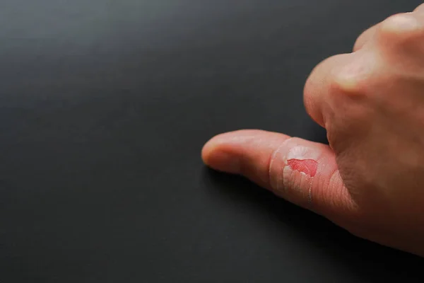 Skinning Skin Fingers Hands One Person Injured — Stock Photo, Image