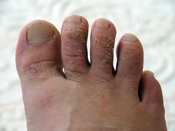 Calos Fúngicos Nos Dedos Dos Pés Coceira Doenças Nos Pés — Fotografia de Stock