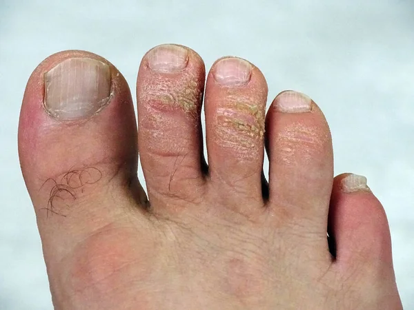 Calos Fúngicos Nos Dedos Dos Pés Coceira Doenças Nos Pés — Fotografia de Stock