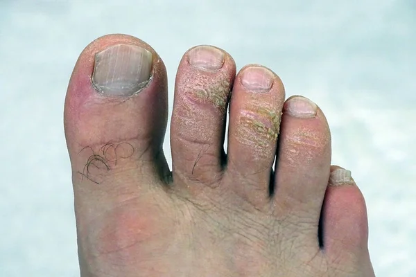 Plísňové Mozoly Prstech Svědivé Nemoci Nohou Plísňové Onemocnění Prstech — Stock fotografie