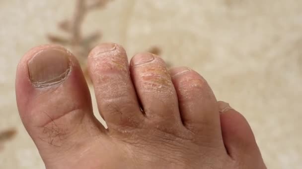 感冒和脚趾上的真菌病 被忽视的人的脚 — 图库视频影像