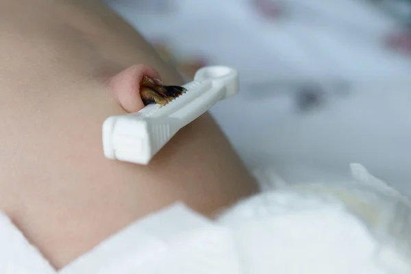 Umbilical cord with clamp of newborn baby close-up — Stock Photo, Image