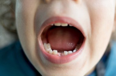 Diş hekiminde dişleri dökülen bir çocuk.