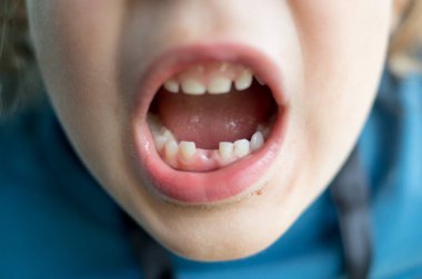 Diş hekiminde dişleri dökülen bir çocuk.