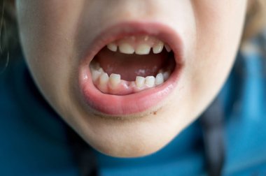 Altı yaşında bir çocuk dişini kaybettikten sonra dişlerini gösteriyor.