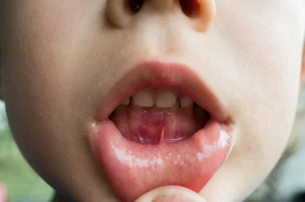 Çocuk kırmızı sakızını gösteriyor çünkü bir diş düşmek üzere.