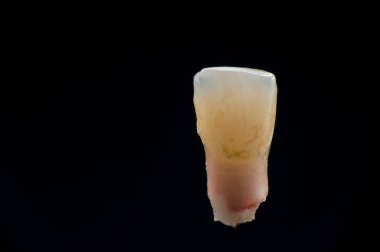A newly fallen child's tooth, isolated on a black background