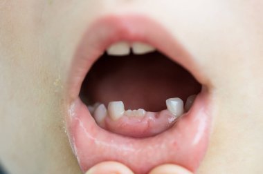 Dişleri dökülen çocuk yenileriyle ağzını gösteriyor.