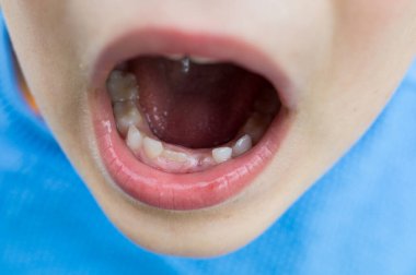 Ağzı açık büyüyen dişini gösteren bir çocuk.