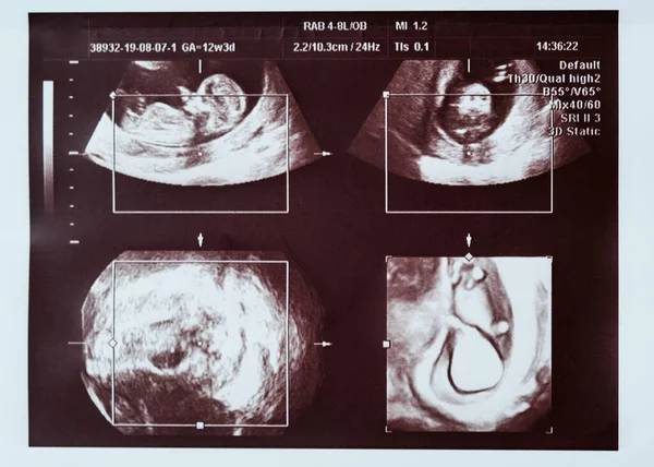Bébé sous échographie. 20 semaines de gestation. Collage, angles différents. — Photo