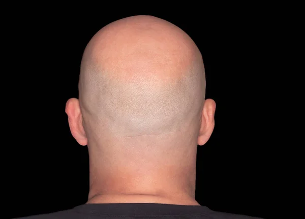 Bakifrån Ett Skalligt Huvud Vuxna Med Alopeci Eller Håravfall Vuxen — Stockfoto