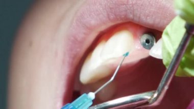 Diş hekimi, dil koruyucuları yerleştirmeden önce dişlere ortodontik mavi yapıştırıcı sürüyor. Ünitesiz üst dişler yerleştirilmeyi bekliyor.