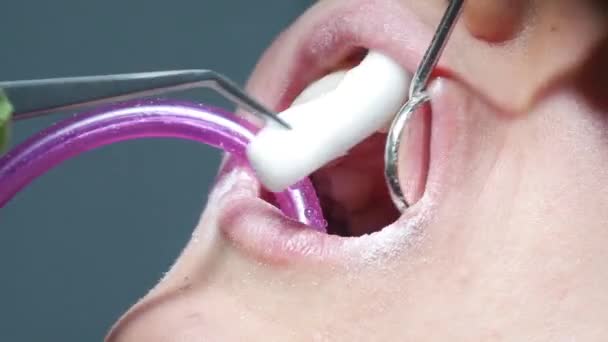 Tandläkare Tar Bort Spot Absorberande Bomull Tampong Från Patientens Mun — Stockvideo
