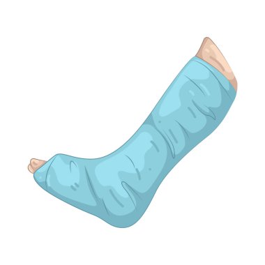 Bacak alçısı iyileşen kemikleri desteklemek için kullanılan sert bir koruyucu kaplamadır..