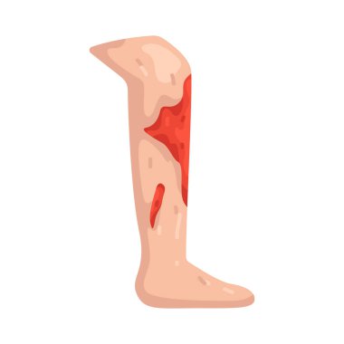 Bacak yaralanması, bacağı etkileyen, hareket problemini ya da fiziksel travmayı sembolize eden bir yaralanmadır..