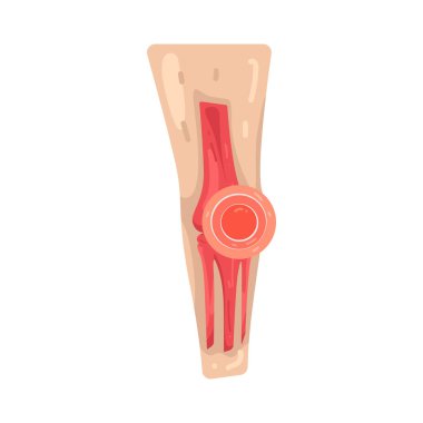Bacak ağrısı bacak kaslarında ya da eklemlerde hareket kabiliyetini etkileyen rahatsızlıktır..
