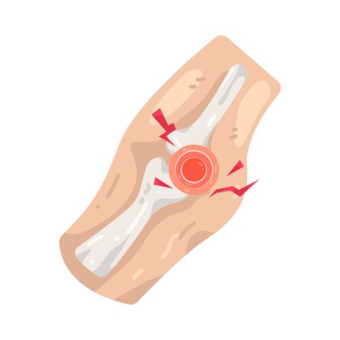 Bacak ağrısı bacak kaslarında ya da eklemlerde hareket kabiliyetini etkileyen rahatsızlıktır..