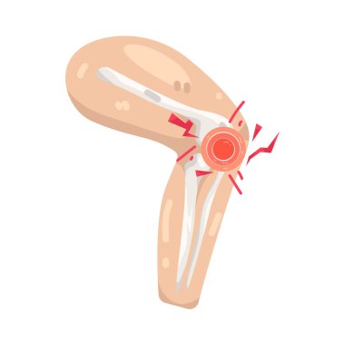 Diz ağrısı yaralanma, eklem iltihabı ya da aşırı kullanımdan kaynaklanan yaygın bir eklem sorunudur..