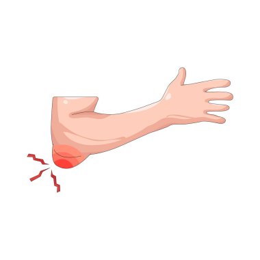 Dirsek ağrısı ya da dirsek ekleminde aşırı kullanım ya da yaralanma nedeniyle oluşan şiddetli bir rahatsızlık..