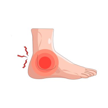 Ayak bileğindeki ağrı genellikle burkulma, gerilme ya da eklem iltihabından kaynaklanır..
