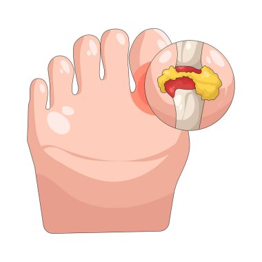 Ayak parmağında kırık olan ayak kemiği, ayak parmağı kemiklerinden birinde şişkinliğe, morluklara ve ağrıya neden olan bir çatlağı temsil ediyor..