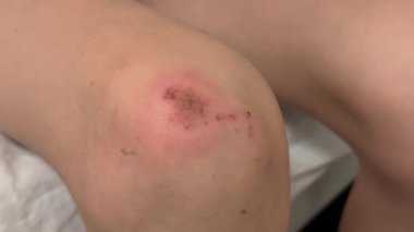 Yaralı dizine yakın plan, taze yara ve derisinde sıyrıklar var.. 