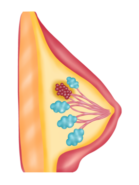 Göğüs kanseri, elle çizilmiş suluboya çizimi