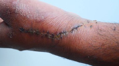 Ameliyat sonrası Koyu Deri Elde Yara ve Dikişler