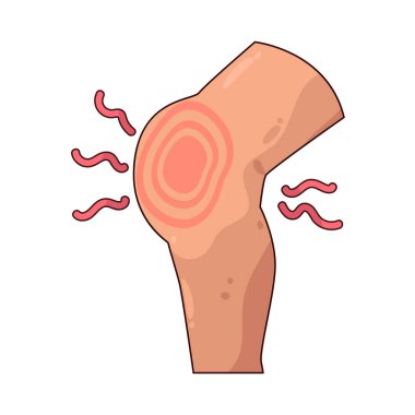  Şişmiş Diz, dizin sıvı birikimi, yaralanma ya da iltihaplanma nedeniyle büyüdüğü durumdur..