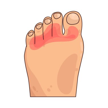 Ayak parmağı ağrısı, yaralanma, basınç ya da iltihap kaynaklı bir ya da daha fazla ayak parmağındaki rahatsızlık ya da tahriş demektir..