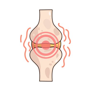 Kırmızı Eklem, tahriş, iltihap ya da kan akışının artması nedeniyle kırmızıya dönmüş gibi görünen bir eklemdir..