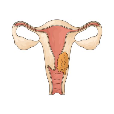 Rahim ağzı kanseri rahim boynundaki anormal hücre büyümesinden kaynaklanan bir hastalıktır..