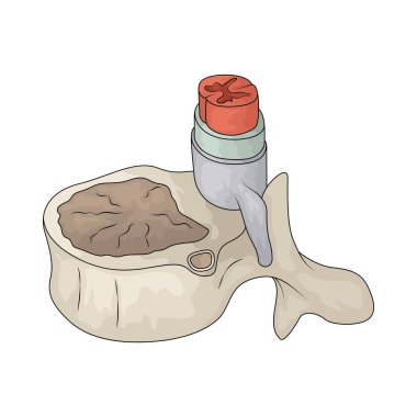 Fıtıklaşmış disk, diskin çıkıntı yaptığı ya da koptuğu, potansiyel olarak ağrı ya da sinir sıkışmasına neden olan omurilik durumudur..
