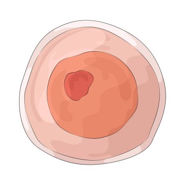 Kanser hücresi kanserle ilişkili anormal hücre büyümesini temsil eder..