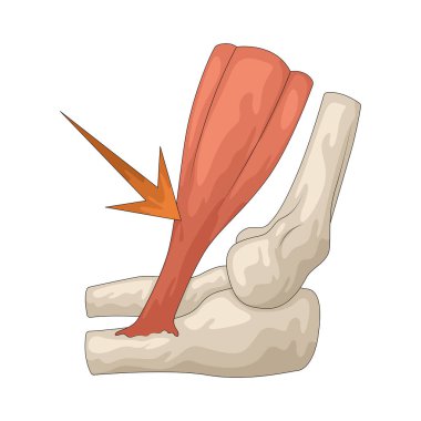 Kas ağrısı, kaslarda gerilim ya da aşırı kullanımdan kaynaklanan durgun ve sürekli bir ağrıdır..
