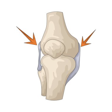 Eklem ağrısı bir ya da daha fazla eklemdeki rahatsızlık, sertlik ya da iltihaplanmadır..