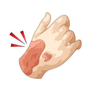 El yanığı yangın, sıcak yüzey ya da kimyasal maddelerle temas sonucu oluşan bir yaralanmadır..