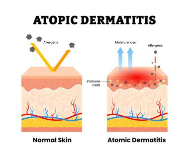 Deri iltihabı ya da deri yapısı normal olan atopik egzama derisi anatomi kesiti. Kuru cilt iltihabı. Filaggrin. Bağışıklık hücreleri, nem kaybı, alerji. Vektör illüstrasyonu.