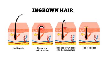 Değişik tipte saç koleksiyonu. Etiketlenmiş sağlıklı saç derisi, sivilce ve iltihap, cilt yüzeyine doğru uzayan saçlar, kapana kısılmış saçlar. Dermatoloji ve güzellik konsepti çizimi