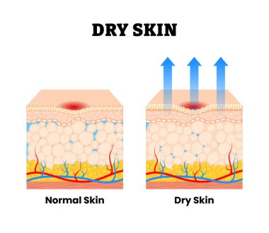 Normal ve kuru cilt. Xerosis veya Xeroderma. Deri çok fazla su ve yağ kaybediyor. Nemlilik kaybı. İnsan derisi anatomi bölümünden. Vektör illüstrasyonu
