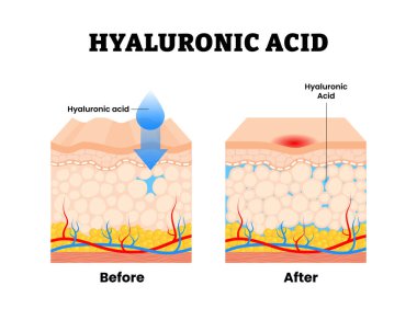 Hyaluronik asit işleminden önce. Cilt yenileme, kırışıklıklar ve kadın derisi için daha pürüzsüz bir yüzey. Yaşlanma karşıtı güzellik yaşam tarzı. İnsan derisi anatomi bölümünden. Vektör illüstrasyonu