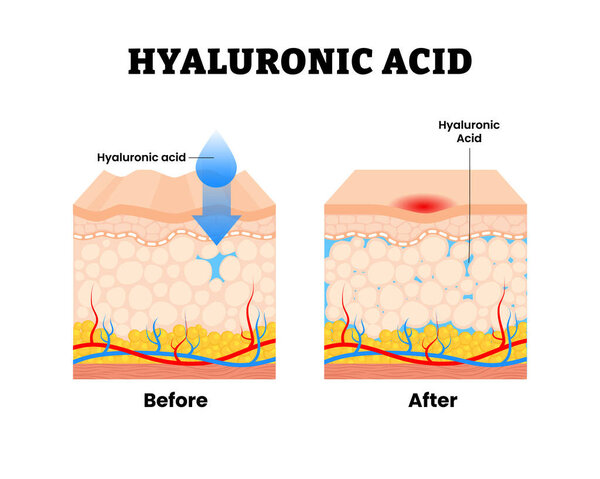 Before after hyaluronic acid procedure. Skin rejuvenation, Wrinkles and smoother surface for woman skincare. Anti aging beauty lifestyle. Human skin layers anatomy cross section. Vector illustration
