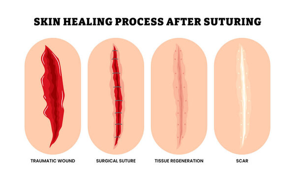 Skin healing process after suturing closure procedure. Wound healing process, Labeled traumatic wound, surgical suture, tissue regeneration and scar formation. Flat vector illustration.