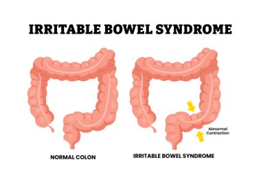 Irritable bowel syndrome. Colon disease. Abnormal contraction in large intestine. Stomach illness. Gastrointestinal disorder. Medical poster design healthcare scheme. Flat vector illustration.