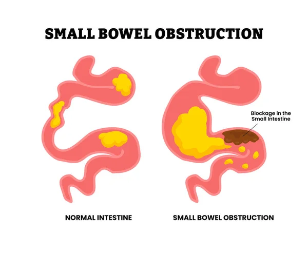 Small bowel obstruction. Blockage in small intestine. Ileus toxic small midgut. Hiatal hernia. Blockage of your small or large intestine. Birth defect infant children, Medical science educational illustration.